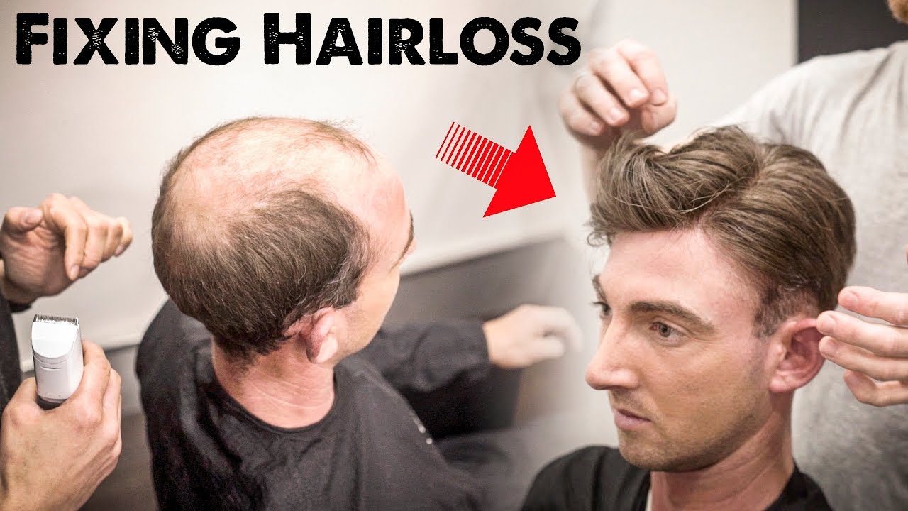 Hair Loss Products vs. Men’s Hairpieces: My Biggest Regret